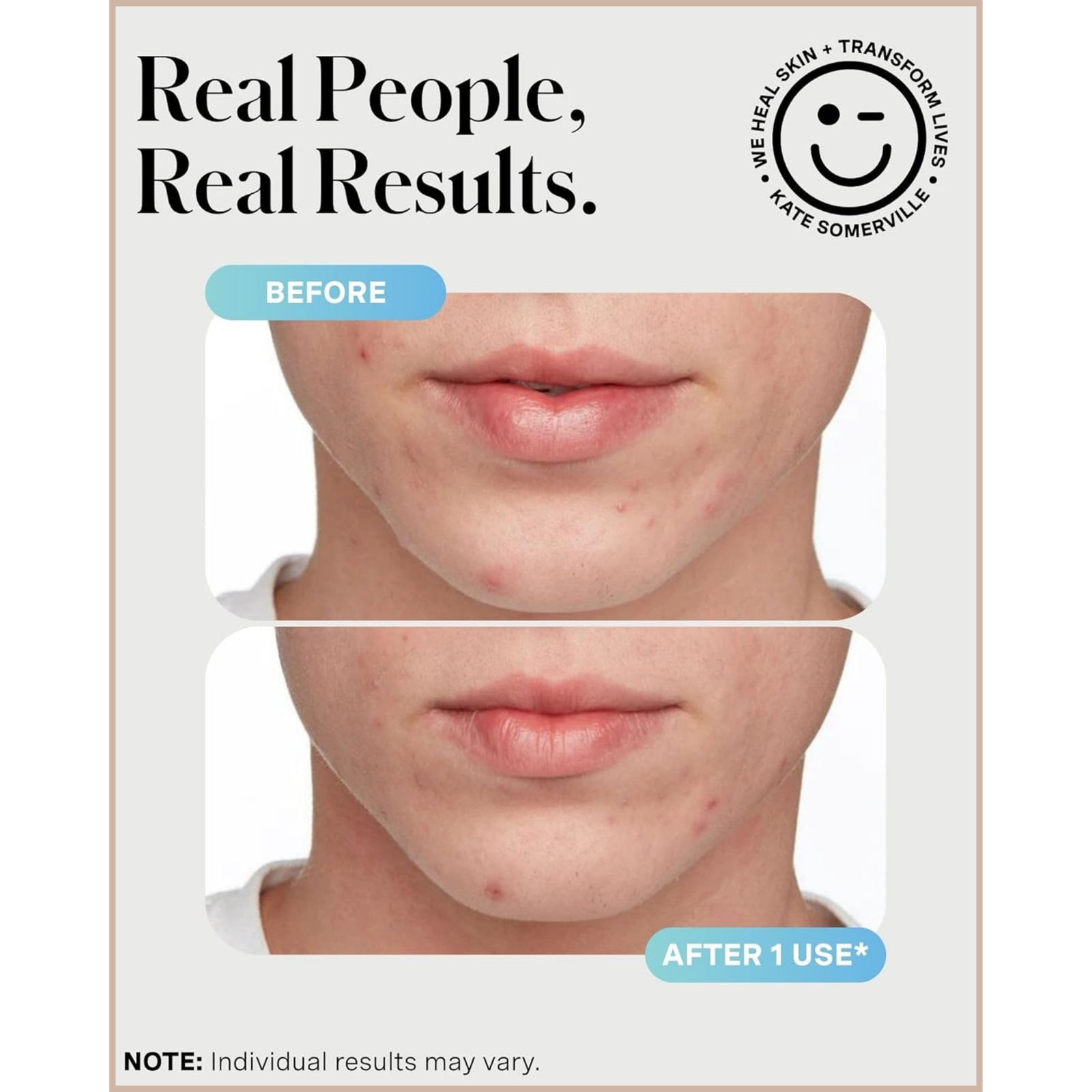 Rapid Acne Spot Treatment with Sulfur & Salicylic Acid for Breakout Reduction - Image 2